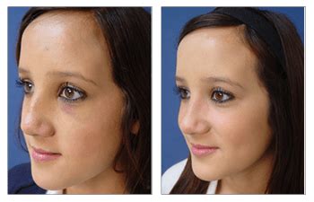 Crooked Nose After Rhinoplasty Cosmetics Surgery