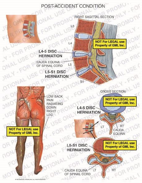 Post Accident Condition 97267a25b Generic Medical Legal Exhibits A Division Of Mvi