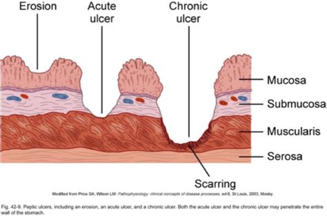 Ulcers Flashcards Quizlet