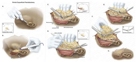 Partial Superficial Parotidectomy | AMI 2019