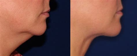 surgical jowl lift nyc dr gary jayne rothfeld board certified