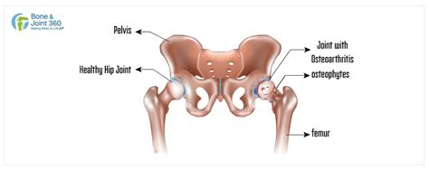 Hip Replacement Surgery- purpose, procedure and more - Robotic Knee ...