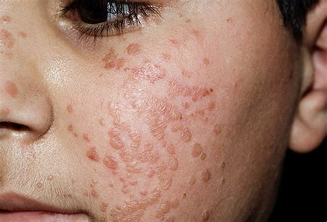 Warts on Face: All Possible Locations, Their Causes, and Effective ...