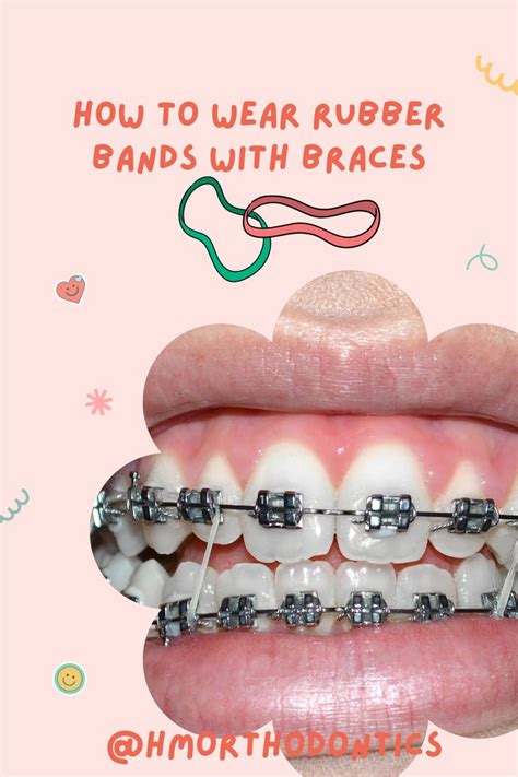 How Do Rubber Bands On Braces Help Marisol Edgar