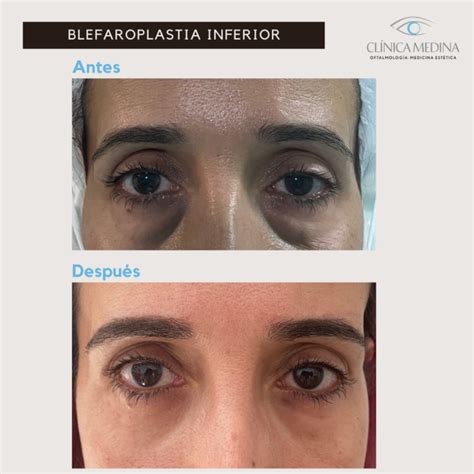 Tratamientos Para Eliminar Bolsas Y Ojeras Blog De Cl Nica Medina