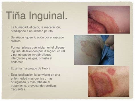 Micosis Superficiales Y Candidiasis