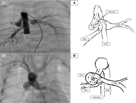 Stenting Of High Tortuous Ducts In Duct Dependent Pulmonary Circulation