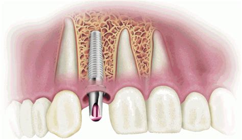 Injertos óseos para implantes dentales Clinica Villarreal