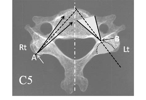 Direction Of Cervical Pedicle Screw After Funnel Like Hole Creation Download Scientific