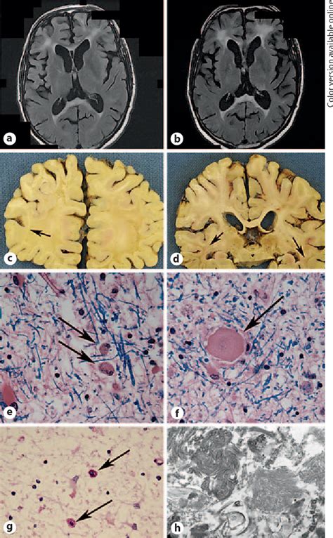 Figure 1 From Adult Onset Leukoencephalopathy With Axonal Spheroids And