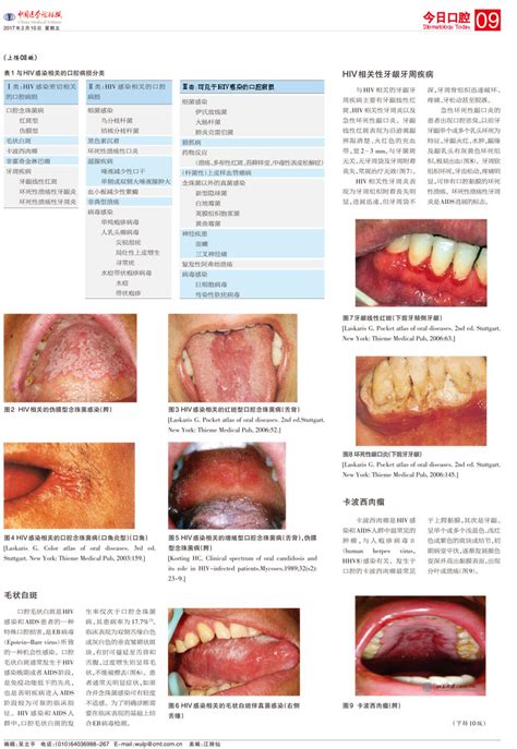 艾滋病口腔表现（终版） 健康知识 北京大学口腔医院