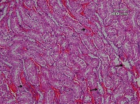 Moderate Renal Lesions Including Congestion Short Arrows And Tubular