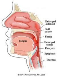 Adenoidectomy Dr Joel S Clear Ent Clinic Trivandrum Best Ent