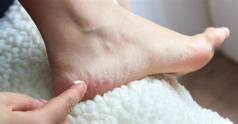 The 5 Best Antifungal Creams For Athlete's Foot