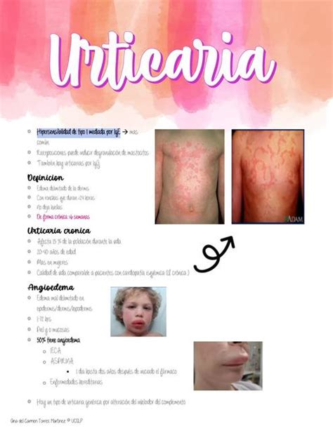 Urticaria Mednotes Ana Udocz