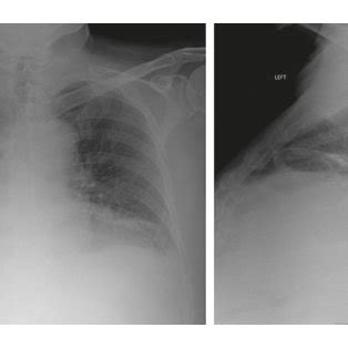 A Portable Upright Chest Radiography Showing Blunting Of The Right