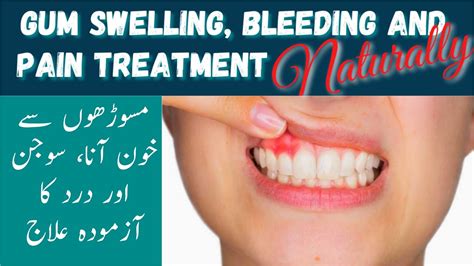 Gum Infection Treatment How To Cure Gum Infection Home Remedies Gum