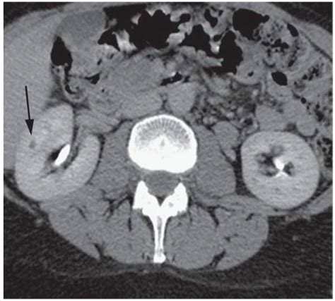 Renal Tumors Radiology Key