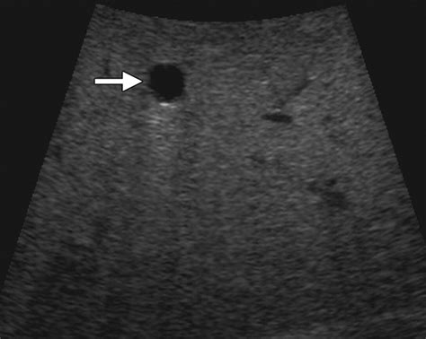 Intraoperative Ultrasonography Of The Pancreas Radiographics