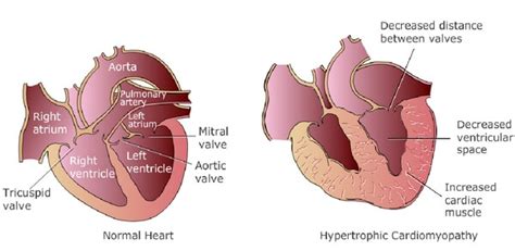 hypertension disease   test  nursing intervention
