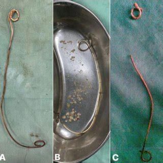 surgical procedures performed to remove retained ureteral stents ...