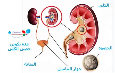 الحصوة في الكلى ووردز