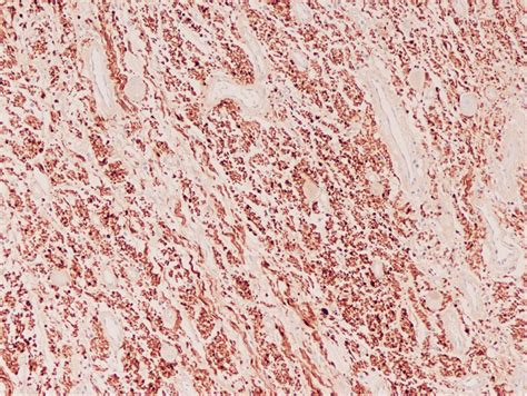 Immunohistochemistry Schwann Cells With S100 Expression Download