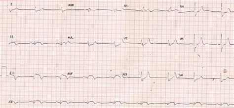 Evolved Inferior Wall Myocardial Infarction Ecg All About Cardiovascular System And Disorders