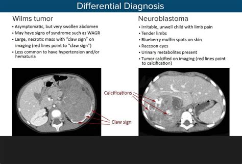 Wilms Tumor A Pediatric Oncology Success Story