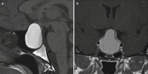 Nonfunctioning Pituitary Adenomas Neupsy Key