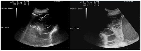 Jcm Free Full Text Ultrasound And Intrapleural Enzymatic Therapy