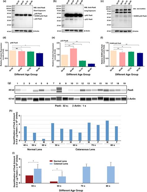 Protein levels of p46 and p32 Pax6 in human cataractous lens epithelial ...