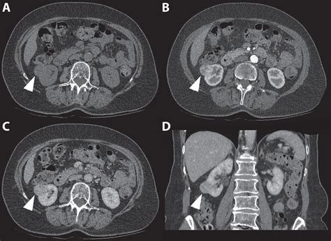 Kidney Tumor Ultrasound