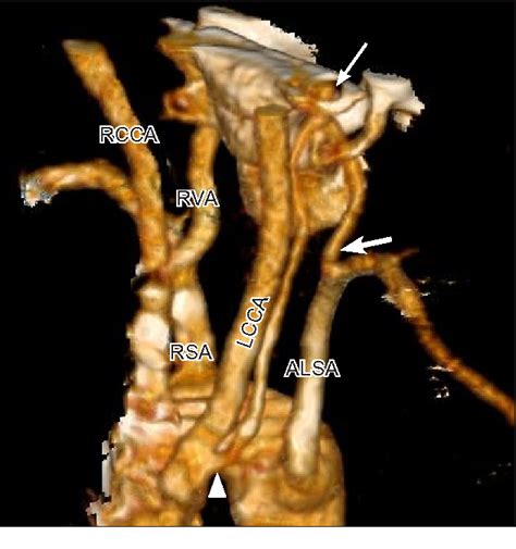 Figure 1 From MDCT Angiography Of Right Sided Aortic Arch With Aberrant