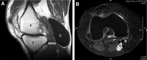 A Sagittal Magnetic Resonance Imaging View Of A Right Knee Download Scientific Diagram