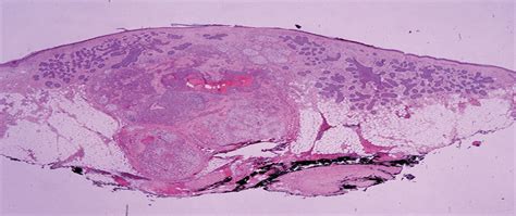 Clear Cell Hidradenoma—basal Cell Carcinoma Collision The American