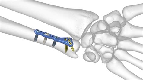 Acu Loc Wrist Plating System Acumed