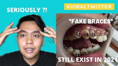 Fake Braces 2021 Real Di Malaysia Seram Tengok Gigi Mangsa 😱😭