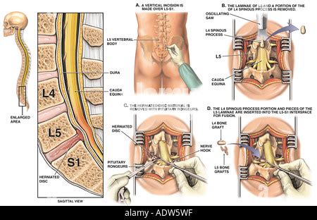 Spinal Fusion Surgery L5 S1 Spondylolisthesis with Surgical Repair of ...