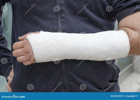 Broken Arm Cast