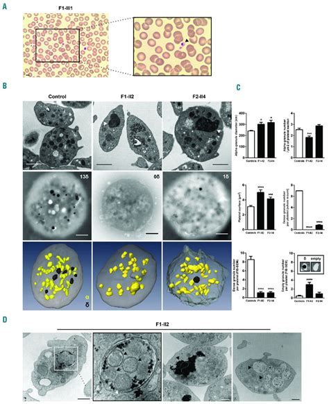 Macrothrombocytopenia And Dense Granule Deficiency Associated With Fli1