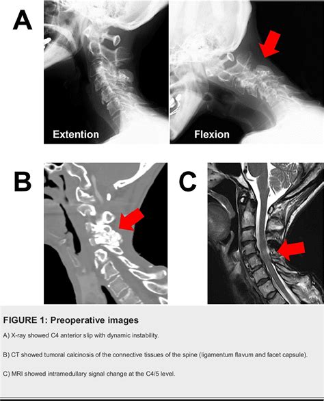 Figure From Late Onset Esophageal Perforation After Salvage Anterior