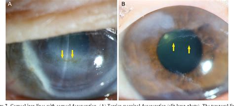 Pdf Corneal Iron Lines Observed In The Clinical Practice Semantic