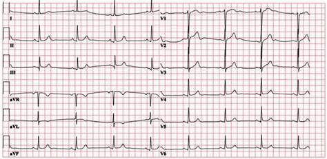 EKG Rhythm Strips Practice Pre Test 2024