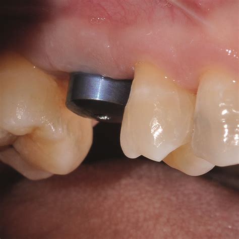 Corona Implantare In Ceramica Ibrida VITA ENAMIC MultiColor