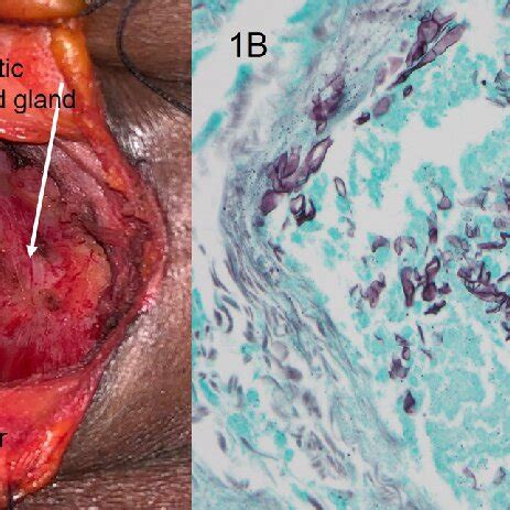 A Intraoperative Photo Showing The Necrotic Thyroid Gland Arrow