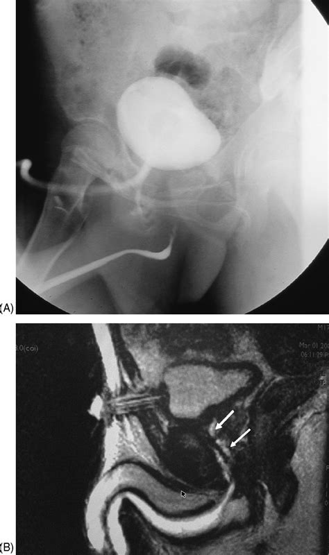 Magnetic Resonance Urethrography In Comparison To Retrograde Urethrography In Diagnosis Of Male