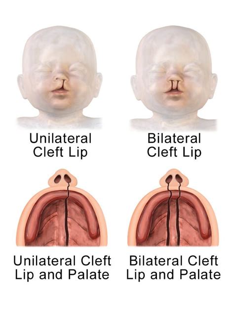 Sumbing Patofisiologi Diagnosis Penatalaksanaan Alomedika