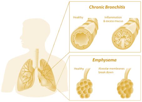 Chronic Obstructive Pulmonary Disorder Copd B Pharma Nd Semester