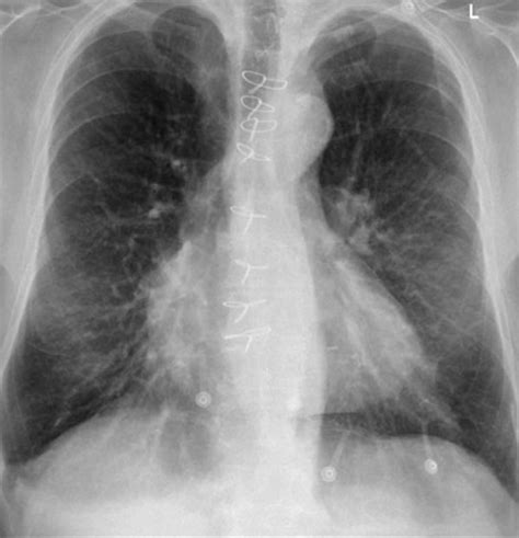 White Spots On Lungs Disease